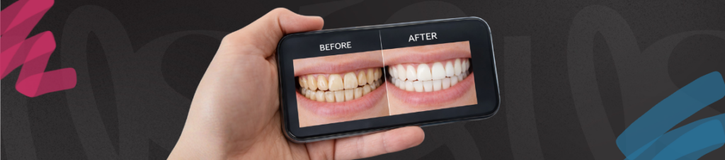 Before and after photo of teeth whitening